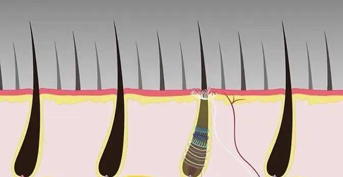 克隆毛囊技术引领植发新时代，最新消息揭秘发展前沿